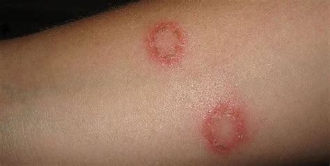 Itchy Rash With Multiple Lesions