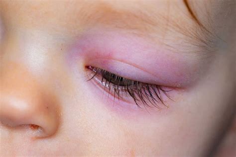 Pink Eye In Babies Causes Symptoms And Treatment Being The Parent