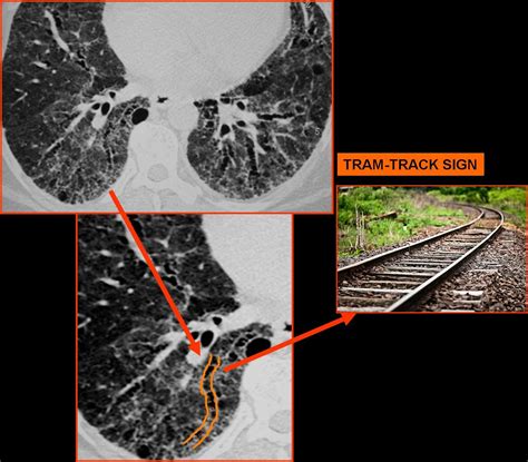 Discover The Tram Track Sign In Chest Ct