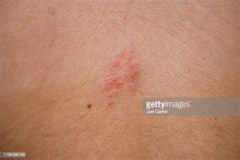 Skin Rashes Photos And Premium High Res Pictures Getty Images