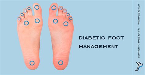 Foot Management For Diabetic Patients Mass4d® Foot Orthotics