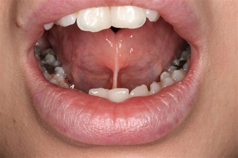 What Is Tongue Tie Ankyloglossia Problems Symptoms Treatment