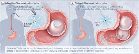 Gastric Balloons For Weight Loss In 2020 Bariatric Surgery Jama