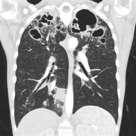 Southwest Journal Of Pulmonary And Critical Care Imaging Medical