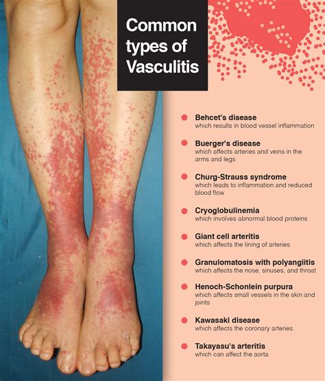 Pictures Of Vasculitis On Skin