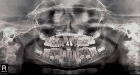 Resumo De Radiografia Panorâmica Radiologia Dica De Dentista