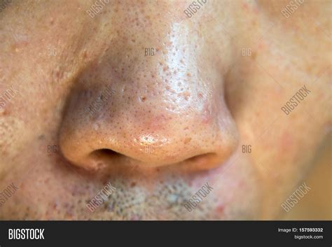 Close Acne Acne Holes Image And Photo Free Trial Bigstock