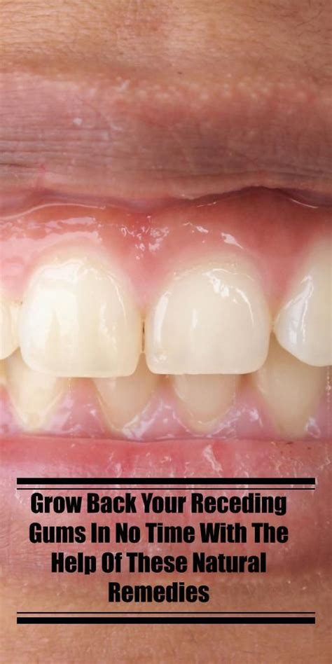 Grow Back Your Receding Gums In No Time With The Help Of These Natural