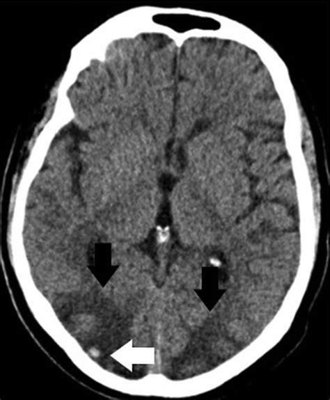 Hemorrhagic Posterior Reversible Encephalopathy Syndrome As A