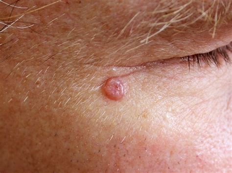 Basal Cell Carcinoma Facial Skin Surgery Worcestershire Ear Nose