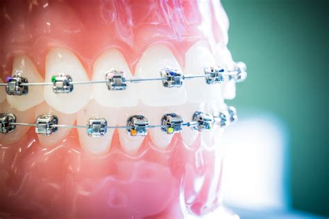 Damon Clear Invisalign Nudera Orthodontics Braces In Chicagoland