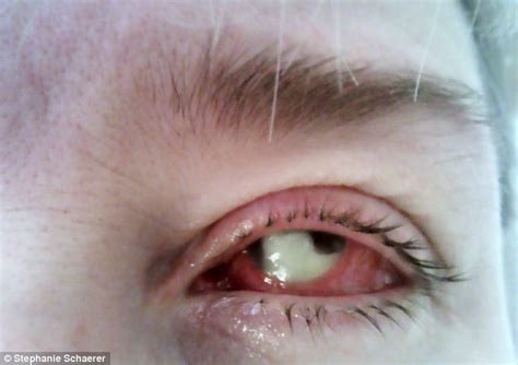 Dailies Contact Lenses Jacqui Stone Has Left Eye Removed After