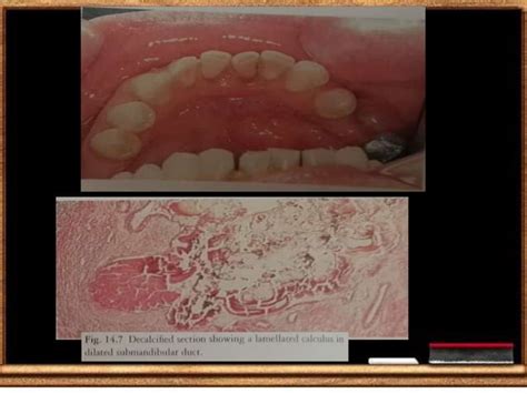 Oral Pathology Diseases Of Salivary Glands Ppt