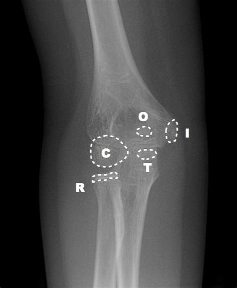 Lateral Condyle Fracture Pediatric Pediatrics Orthobullets