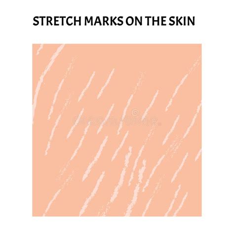 Stretch Marks On The Skin Background Stretch Marks On The Skin