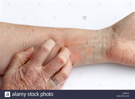 Reddened Skin Stockfotos & Reddened Skin Bilder - Alamy