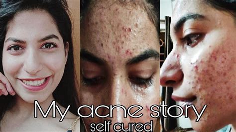 My Pimple Story Part 1 Treatment And Causes How To Reduce Pimples