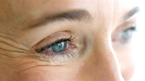 Say Goodbye To Crows Feet Causes And Treatments
