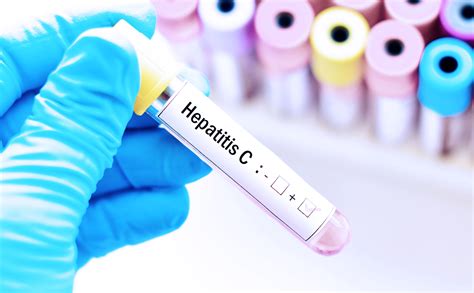 Conoce El Tratamiento De Hepatitis C Centro M Dico Abc