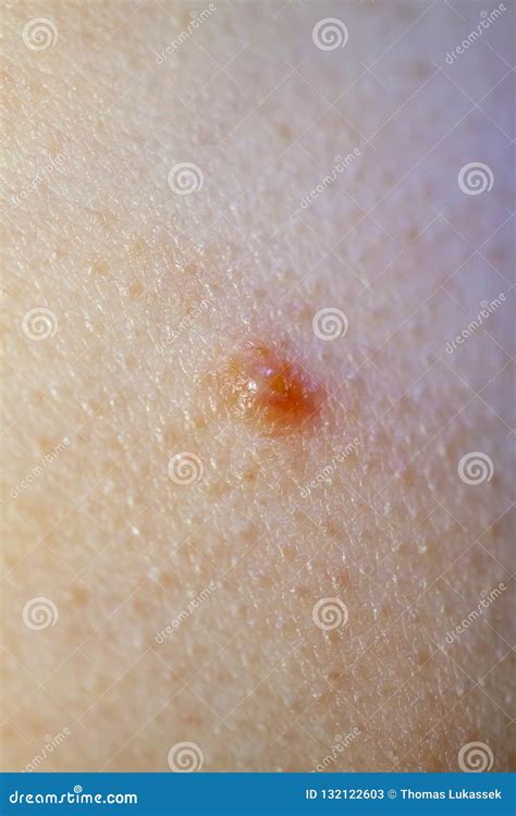 Close Up Of Molluscum Contagiosum Also Called Water Wart Stock Image