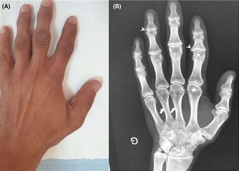 A Swelling Of Proximal And Distal Interphalangeal Joints Associated