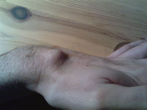 A ganglion cyst is a very common lump within the hand and/or wrist. Ganglion cyst. Pop or not? : popping