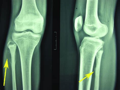 Plain Radiographs Of The Right Knee Showed The Interrupted Periosteal