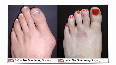 Toe Shortening Procedure Long Ugly Toes Foot First Can Give You A Facelift For Your Feet