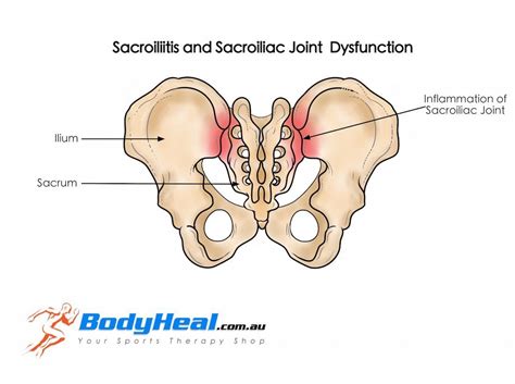 What Is Sacroiliitis Sacroiliac Joint Dysfunction Causes Symptoms Treatment Options