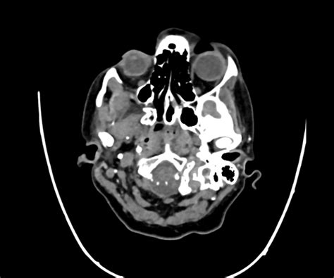 Normal Head Ct Angiogram Image