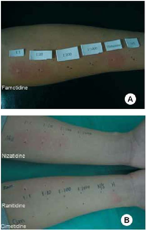 Intradermal Skin Tests With H Receptor Antagonists On The 2 Forearm Of