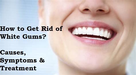 How To Get Rid Of White Gums Causes Symptoms And Treatment Generalskup