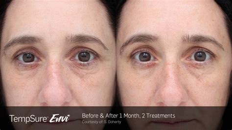 skin tightening grand river eye care