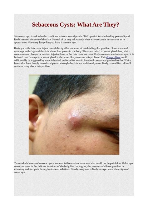 Sebaceous Cysts What Are They