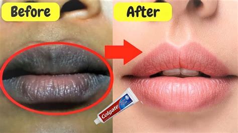 Amazing Tips How To Get Pink Lips Fast Permanently ।। Lighten Dark