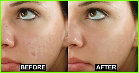 Remove Age Spots And Hyper Pigmentation With This Amazing Natural