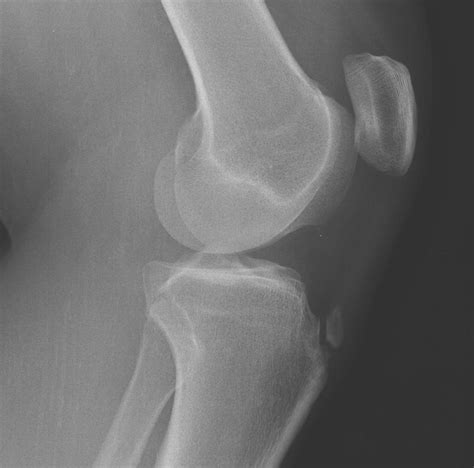 X Rays Of Osgood Schlatters Disease Captions Trend Update