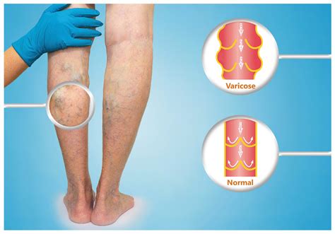 Best Vein Specialist Maryland Varicose Veins Laurel The Vein Center