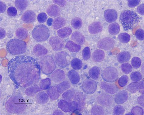 Lymph Node Eclinpath