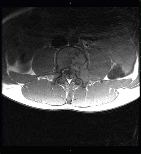 Aneurysmal Bone Cyst Secondary To Osteoblastoma Neuro Mr Case