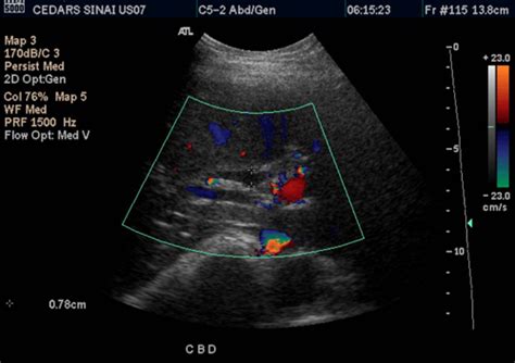 abnormal abdominal ultrasound