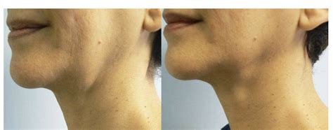 Read About How We Use Non Invasive Technology To Help In Double Chin