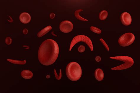 Scd can lead to lifelong disabilities and reduce average life expectancy. Most Children with Sickle Cell Anemia Not Receiving Key ...