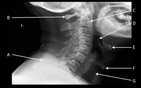 Lateral Plain Radiograph Of The Cervical Spine The Bmj