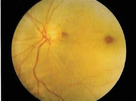 4 Pale Retina With Collapsed Vessels In Left Eye Along With Notable