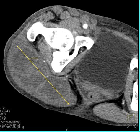 Abscess In The Buttocks Musculoskeletal Case Studies Ctisus Ct Scanning