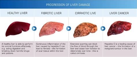 How Does Alcohol Affect The Liver More Serious Than You Thought