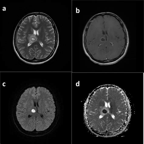 Abscess T2wi Shows Right Thalamic Cystic Lesion With Distinct