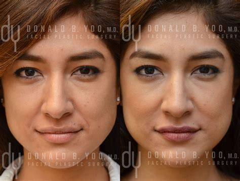Before And After Treating Nasolabial Fold Smile Lines With Juvederm