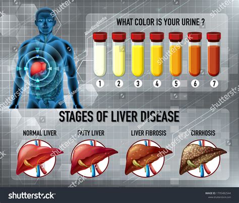 Stages Liver Disease Illustration Stock Vector Royalty Free 1795482544